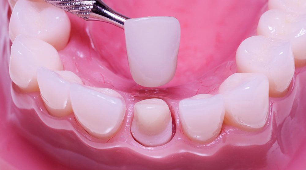 Bọc răng sứ là gì Bọc răng sứ là gì