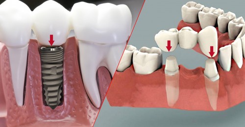 Phục hình răng mất – Cầu răng, hàm giả hay implant? Phục hình răng mất – Cầu răng, hàm giả hay implant?
